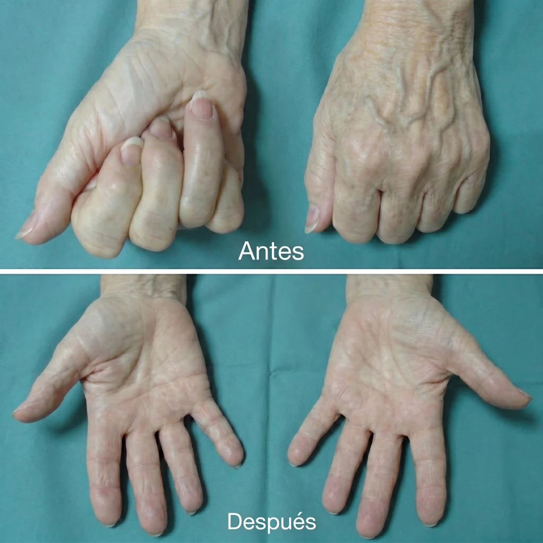 Más facilidad para abrir y mover la mano